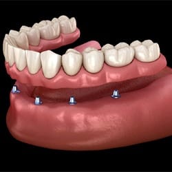 A digital image of implant dentures in Fairfax on the lower arch