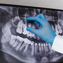 dentist pointing to an infected tooth on an X-ray
