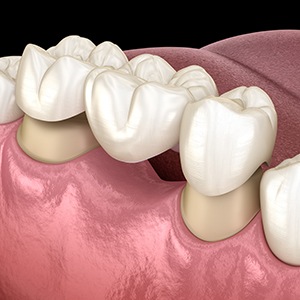 Bridge gaps in your smile with a dental bridge