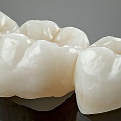 Dental bridges are durable lifelike prosthetics