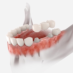 Traditional dental bridges are a popular way to restore your smile