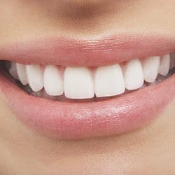 Closeup of beautiful smile after porcelain veneer treatment