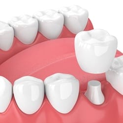 3D illustration of a dental crown