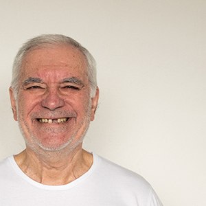 A close-up of a man with missing teeth