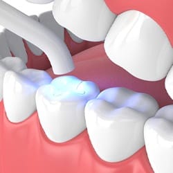 Curing light used during dental bonding treatment