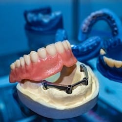Model implant-retained denture