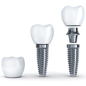 Diagram highlighting components of dental implants in Fairfax