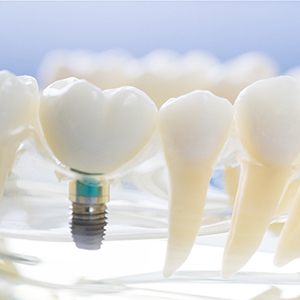 Dental implant in Fairfax inside of a dental model
