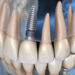 Diagram showing an integrated dental implant inside of a model