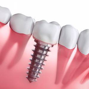 Diagram of dental implants in Fairfax