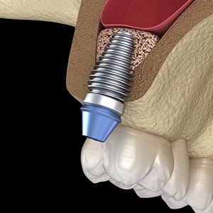 Diagram of sinus lift in Fairfax for dental implant