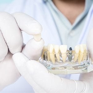 Fairfax implant dentist holding final restoration and model teeth