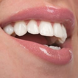 Closeup of straight healthy smile after malocclusion treatment