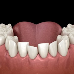 a 3D representation of crowded teeth on a lower jaw