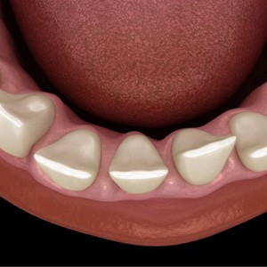 a 3D depiction of gaps between teeth