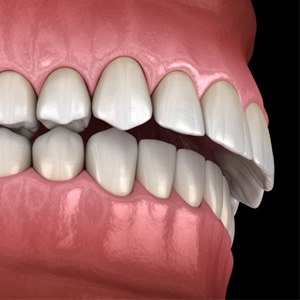 a 3D representation of teeth forming an overbite