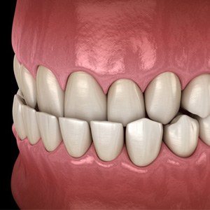 a 3D depiction of teeth forming an underbite