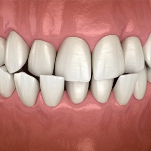 a 3D illustration of teeth forming a crossbite
