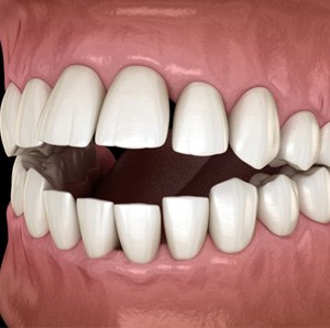 a 3D illustration of teeth forming an open bite
