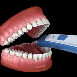 Illustration of scanning wand taking impression of teeth