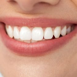 Closeup of healthy smile after metal free dental restoration