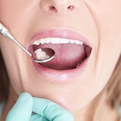 Closeup of healthy teeth after dental sealant placement