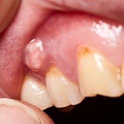 person with a pimple-like bump on their gums