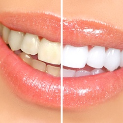 Close-up of woman’s smile before and after teeth whitening in Fairfax, VA