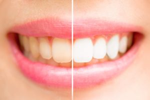 A yellow smile compared to a whitened smile.