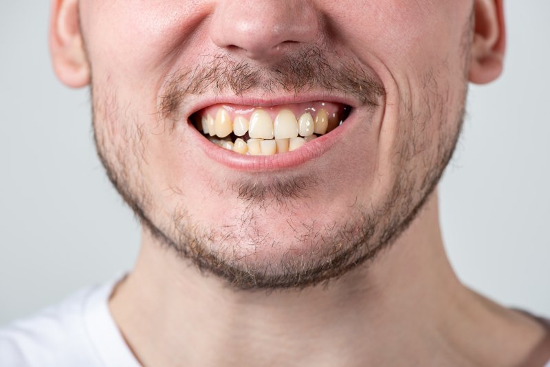 Uneven teeth, one of the most common cosmetic dental flaws
