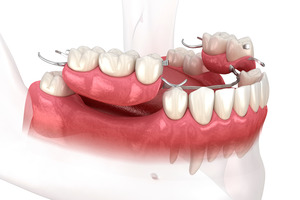 Illustration of a partial denture replacing teeth in lower jaw