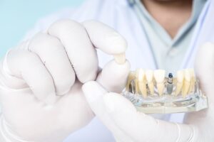 Gloved hands holding model teeth with implant post and sample dental crown